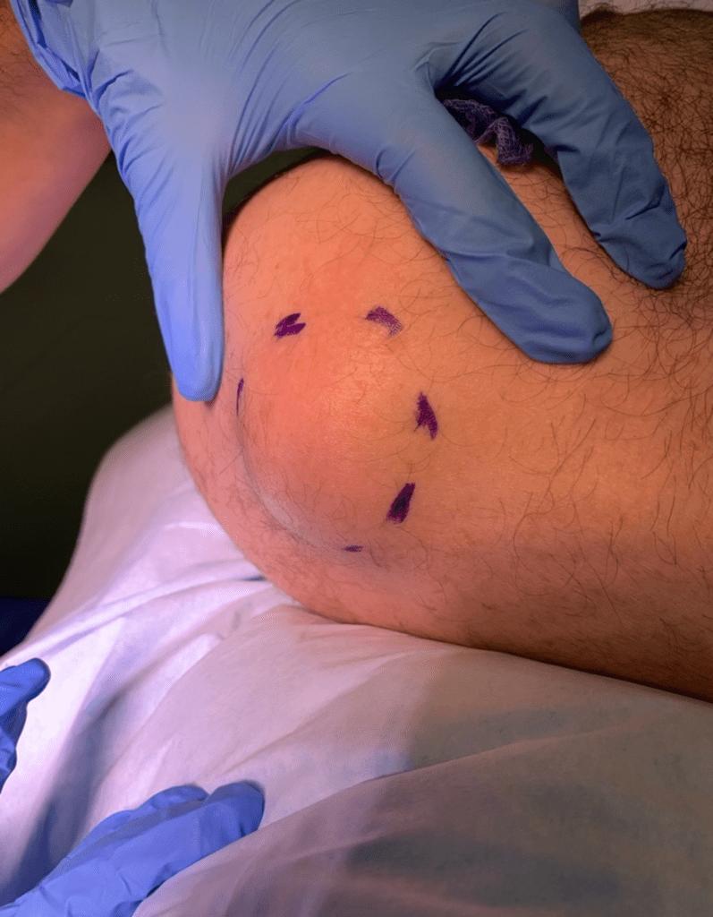 Lipoma on the shoulder also know as a fatty lump