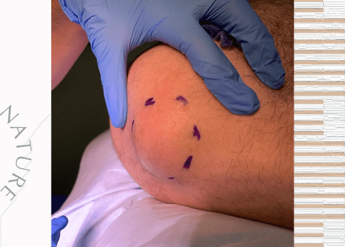 Lipoma on the shoulder