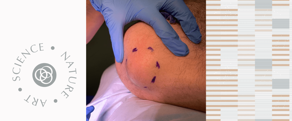 Lipoma on the shoulder