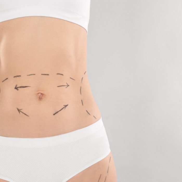 Liposuction Works