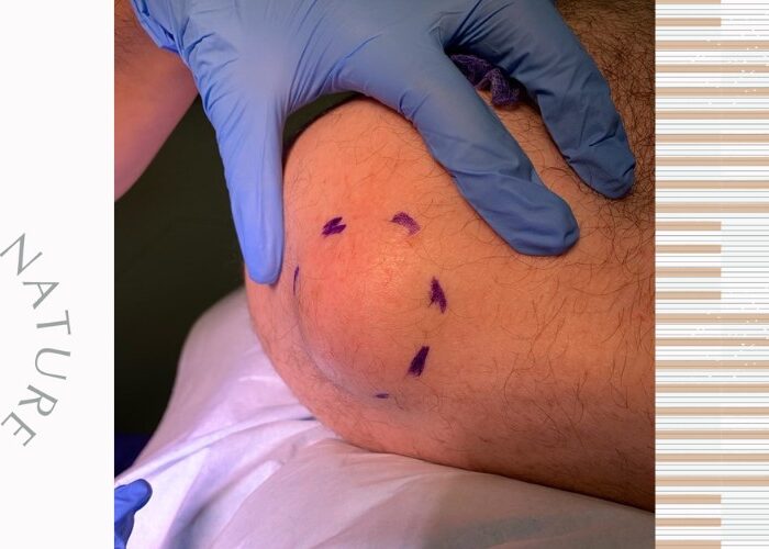 lumps-and-bumps-mole