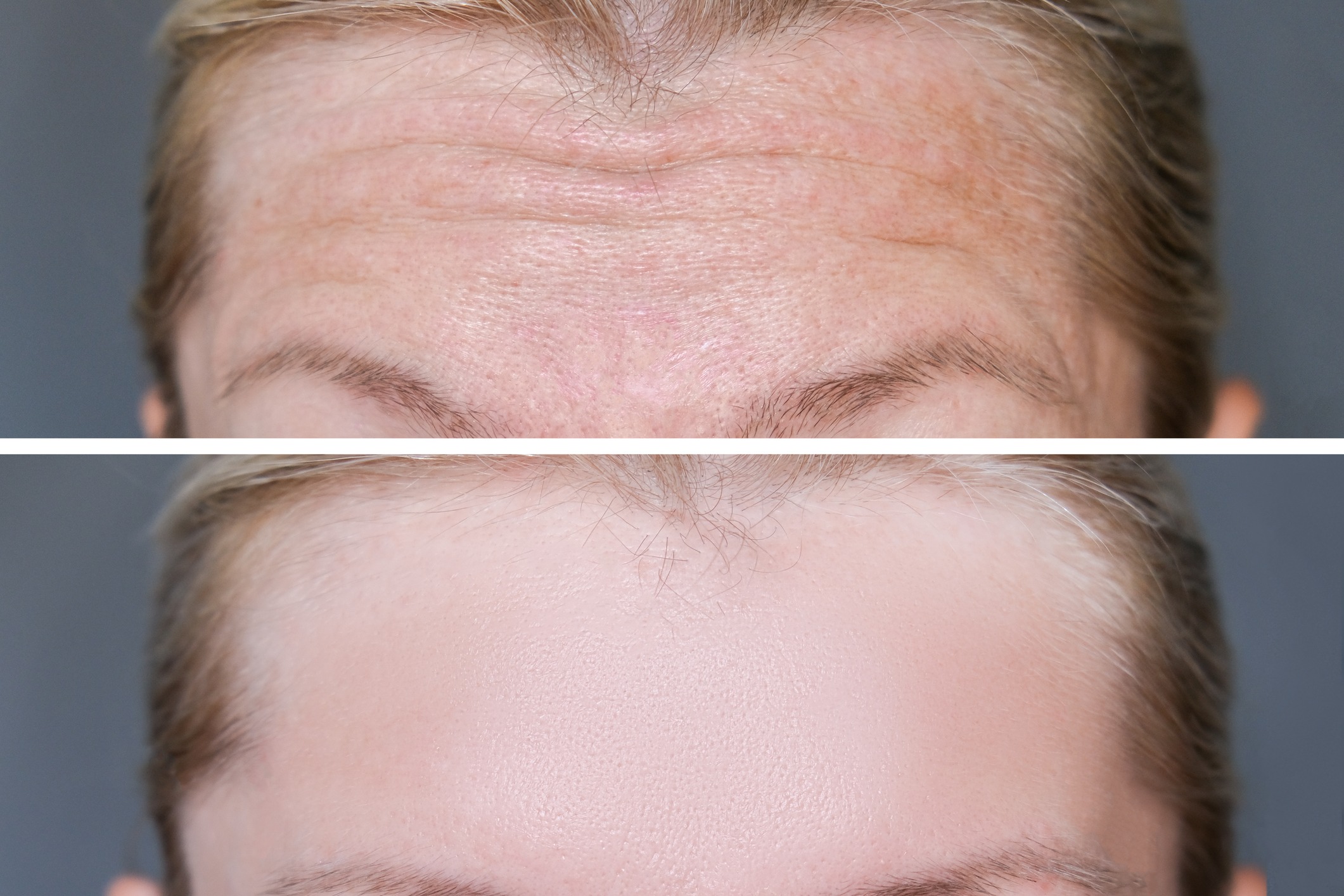 Forehead wrinkles before and after treatment