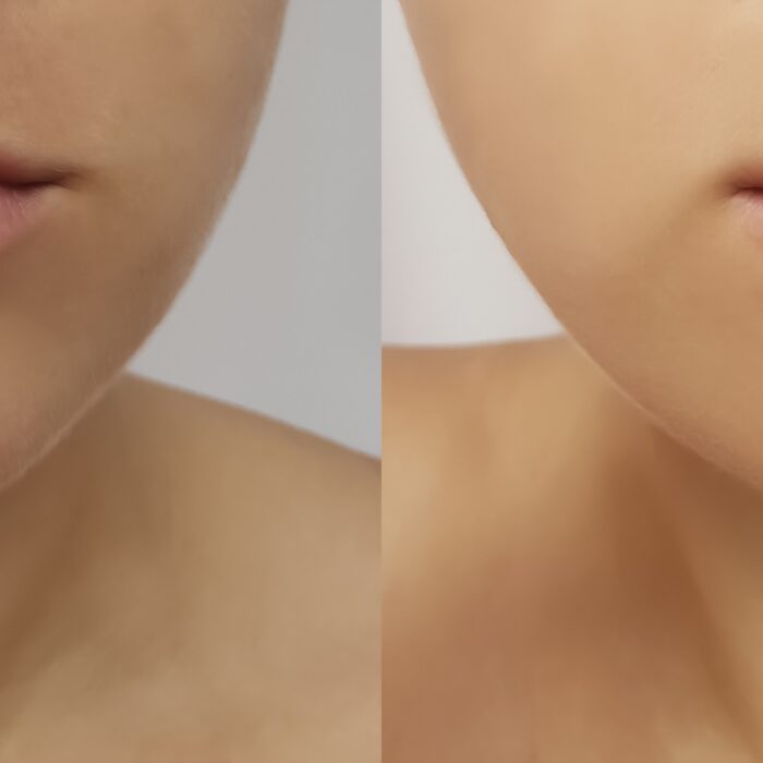 Girl's lips before and after fillers