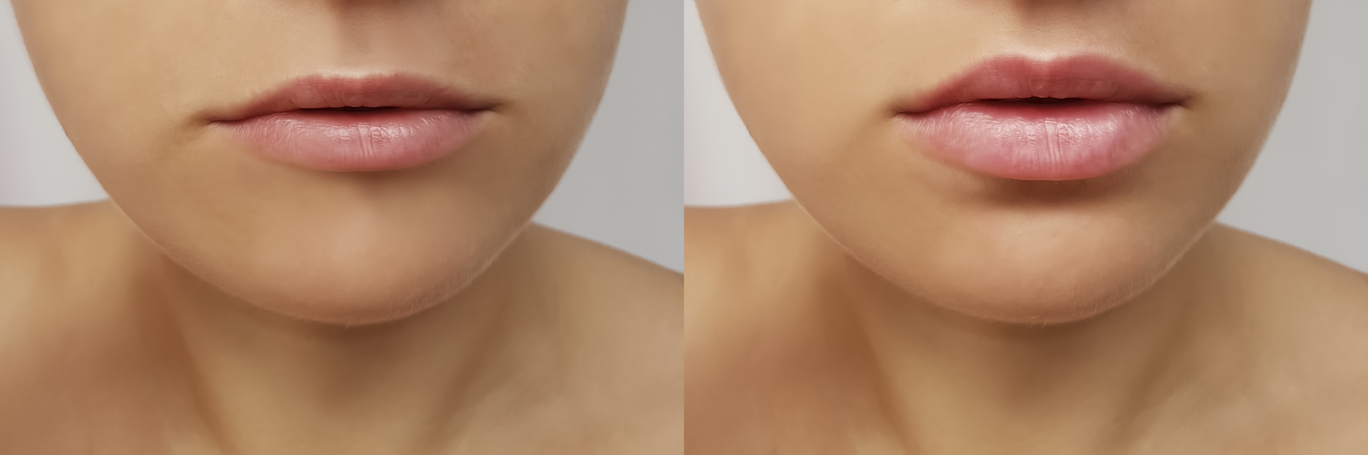 Girl's lips before and after fillers