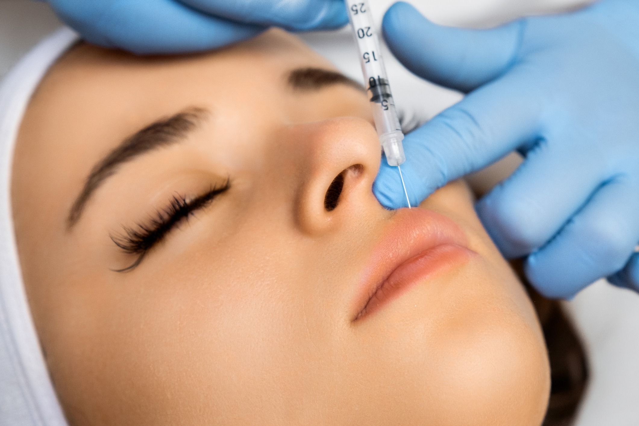 Lip filler injected into the upper lip