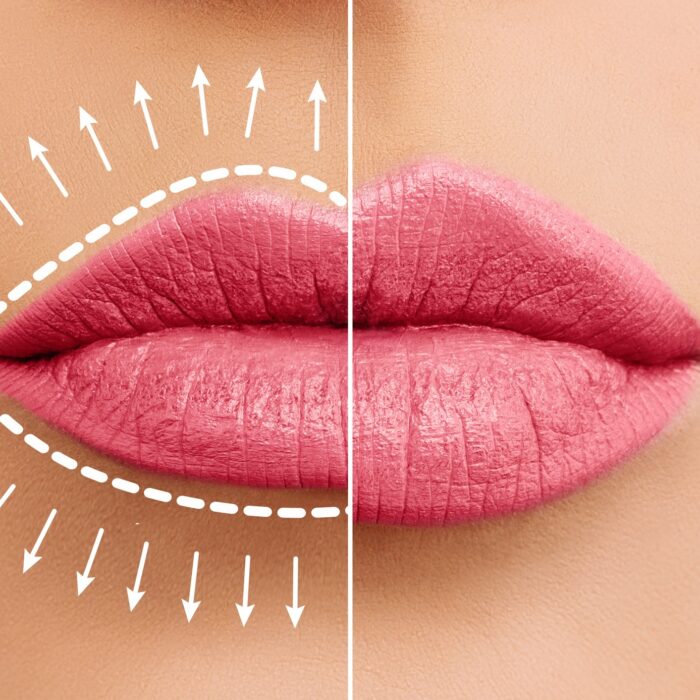Lip augmentation concept