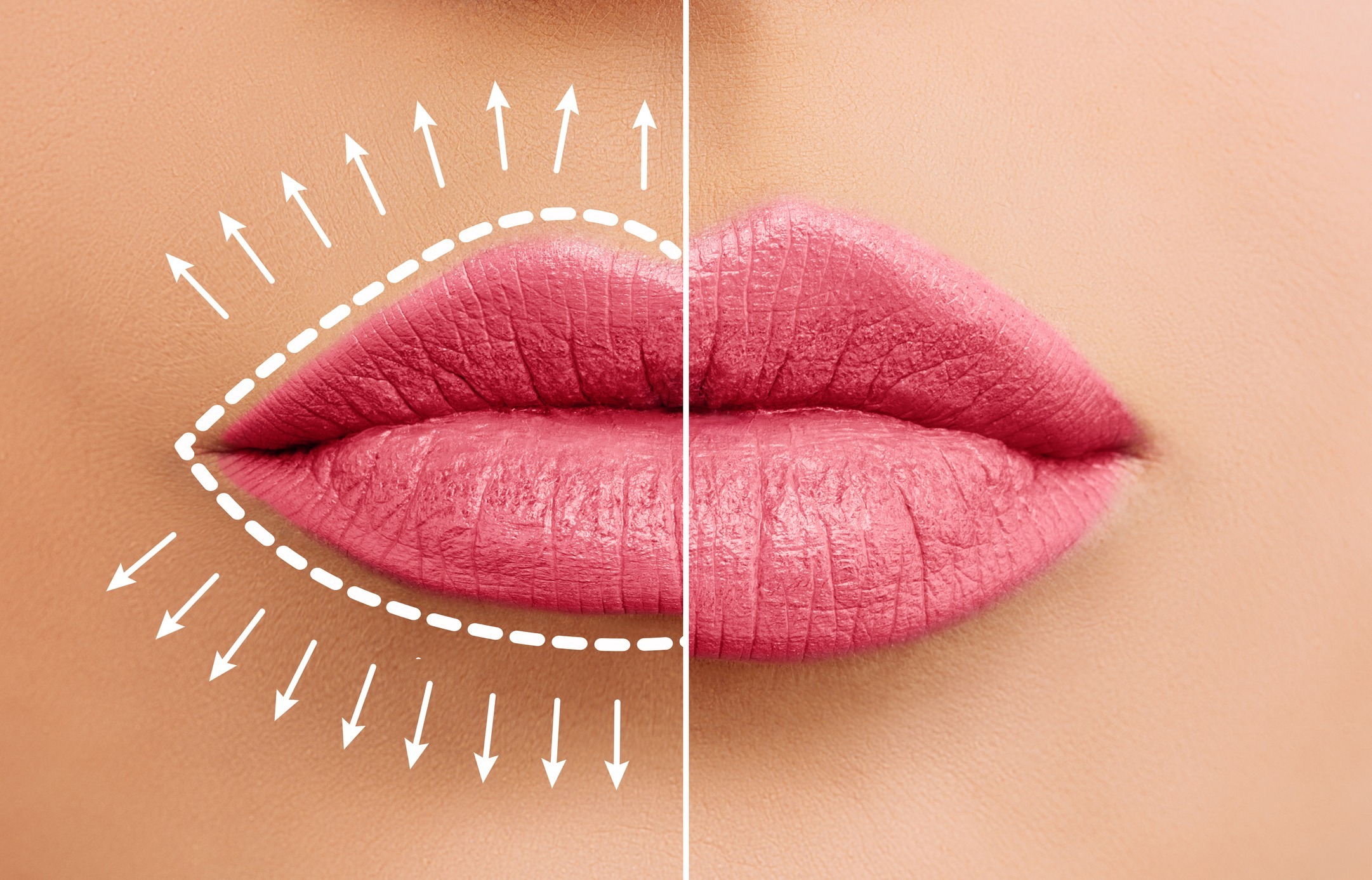 Lip augmentation concept